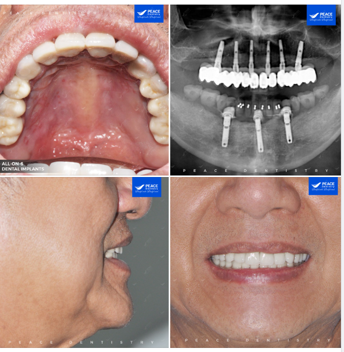 ​​​​​​​ CA LÂM SÀNG ALL-ON-6 IMPLANT CHO HÀM TRÊN VÀ HÀM PHỦ TRÊN IMPLANT CHO HÀM DƯỚI