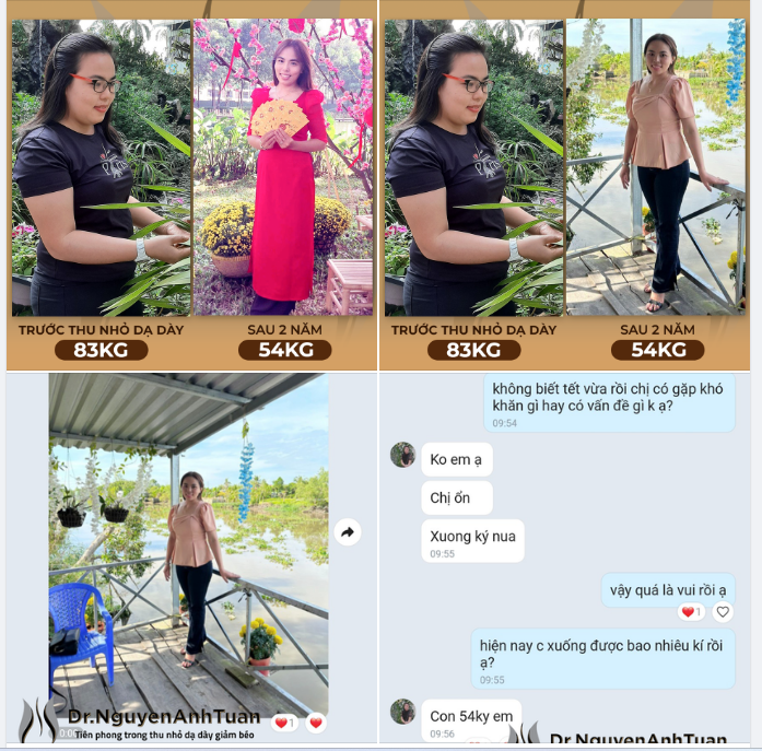 Nhiều bệnh nhân thường băn khoăn: Sau phẫu thuật thu nhỏ dạ dày giảm béo liệu có tái béo không?