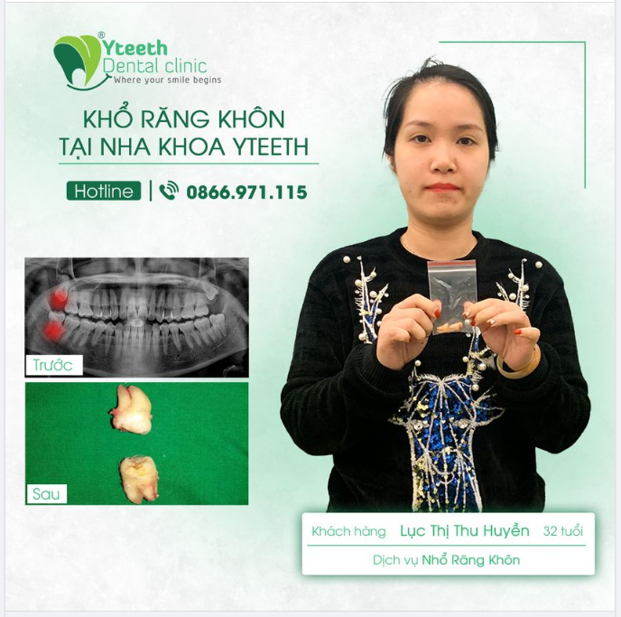 Nhổ răng khôn không đau, nhanh lành thương.