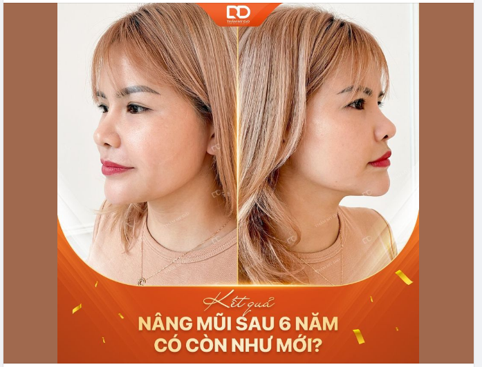 KẾT QUẢ NÂNG MŨI TẠI DrD SAU 6 NĂM ĐẸP KHÔNG CẢ NHÀ?