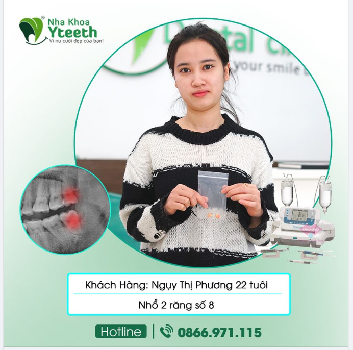 Nhổ răng khôn chưa bao giờ lại nhẹ nhàng và nhanh đến vậy.