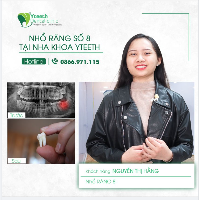 Nhổ răng khôn nhẹ nhàng, êm ái.