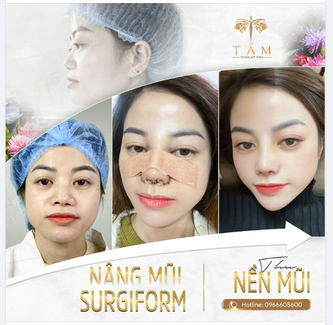 Hình ảnh thực tế khách hàng nâng mũi Surgiform + Thu nền mũi lại Thẩm mỹ viện Tấm