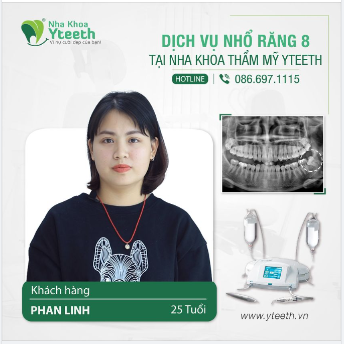 Răng khôn mọc lệch nhổ có đau không?