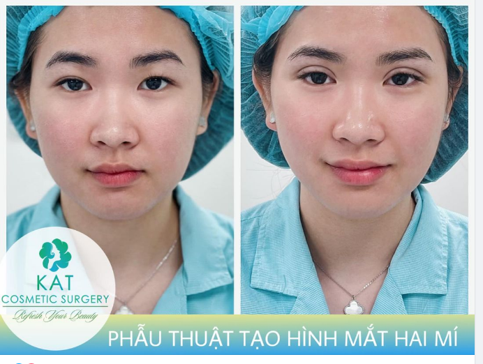 Một đôi mắt hai mí long lanh có thể giúp bạn trông tươi tắn hơn bao nhiêu phần .