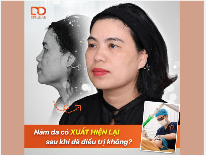 NÁM DA CÓ XUẤT HIỆN TRỞ LẠI SAU KHI ĐÃ ĐIỀU TRỊ KHÔNG?