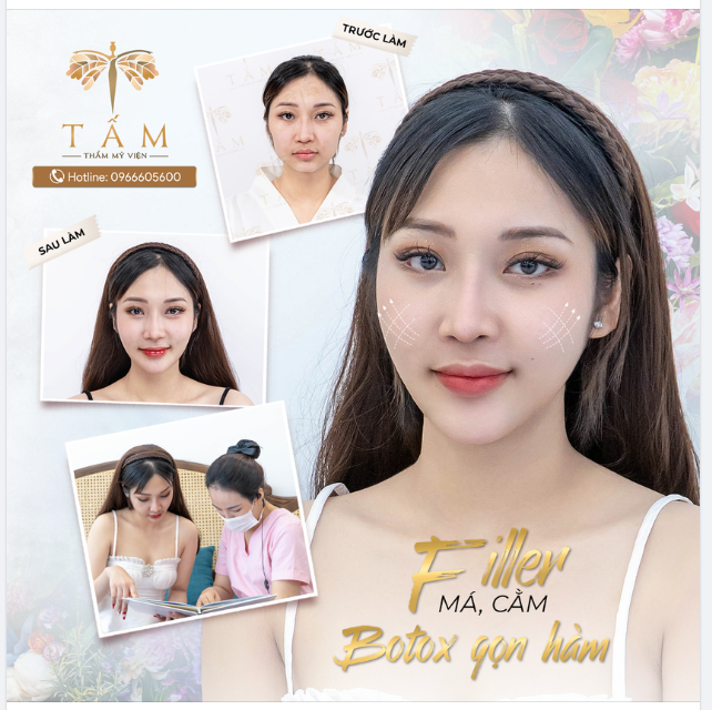 Combo BOTOX - FILLER biến hình gương mặt đẹp hoàn hảo chuẩn tỉ lệ vàng