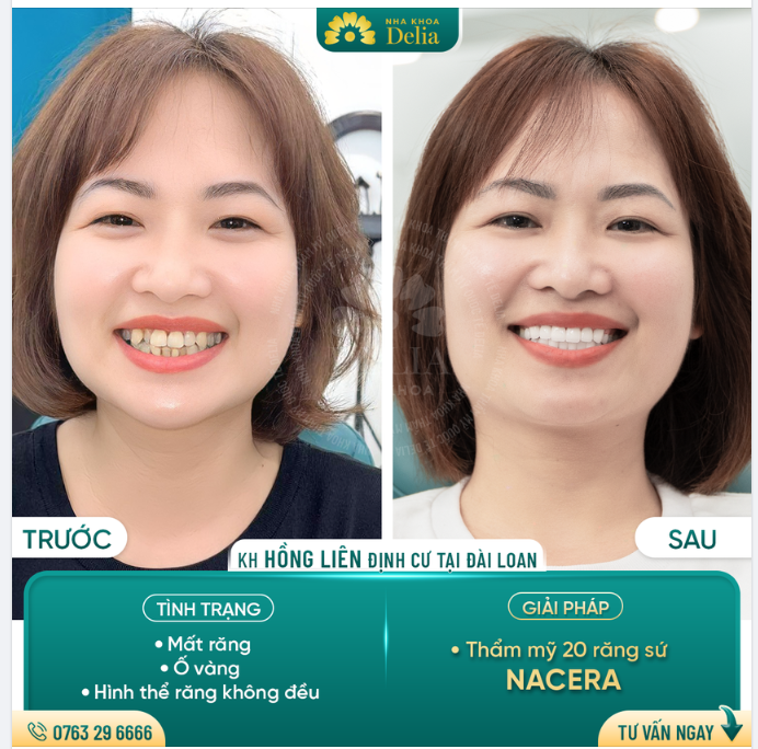 Chị Hồng Liên trở về từ Đài Loan và đến nha khoa Delia với mong muốn khắc phục tình trạng: Răng ố vàng, hình thể răng không đều.