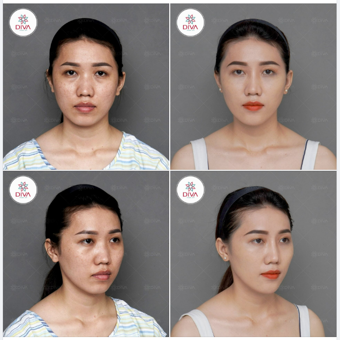 SAU 3 TUẦN NÂNG MŨI, LẤY MỠ MÍ DƯỚI THAY ĐỔI NHƯ THẾ NÀO?