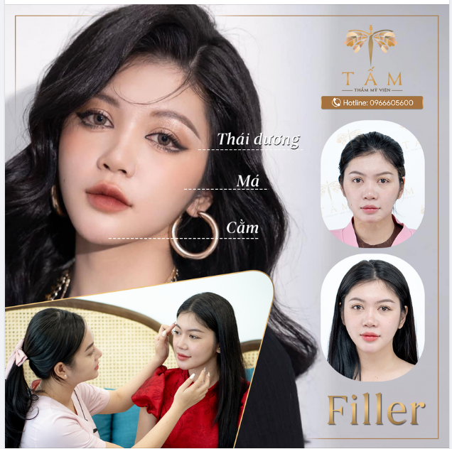 Lột xác ngoạn mục với Combo Filler Thái dương - Má - Cằm
