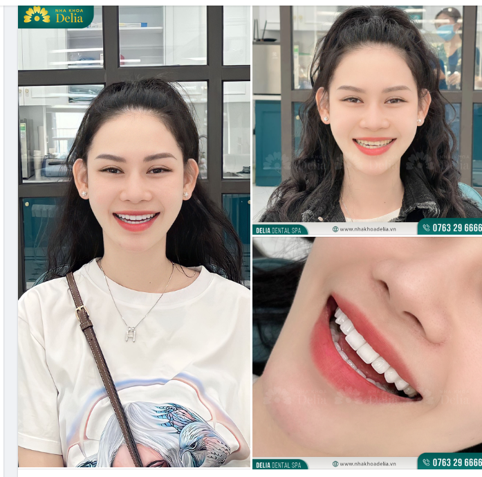 Thẩm mỹ 16 răng sứ Emax - Khoác lớp áo mới cho men răng
