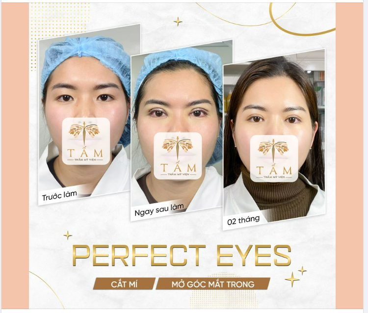 Đôi mắt đẹp tự nhiên sau 2 tháng thực hiện Perfect Eyes tại TMV Tấm