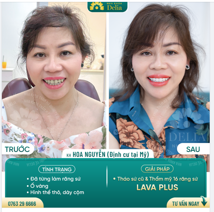 Thẩm mỹ 16 răng sứ Lava Plus - Kiều bào Mỹ sở hữu nụ cười trắng sáng - Chắc khỏe