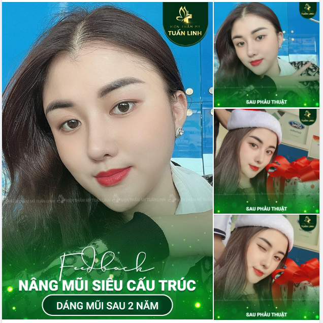 DÁNG MŨI SAU 2 NĂM NÂNG TẠI TUẤN LINH - KHÔNG THỂ XUẤT SẮC HƠN!!