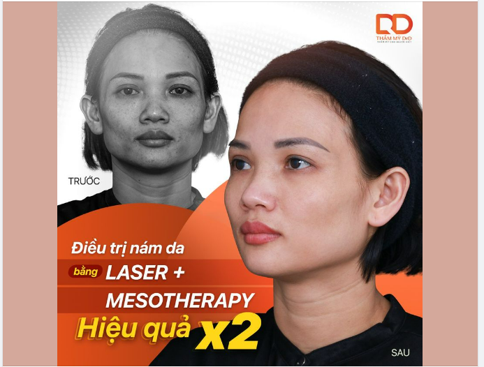 ĐIỀU TRỊ NÁM BẰNG LASER KẾT HỢP MESOTHERAPY CÓ HIỆU QUẢ VƯỢT TRỘI.