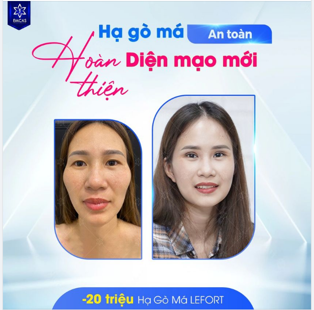 HẠ GÒ MÁ AN TOÀN - HOÀN THIỆN DIỆN MẠO MỚI