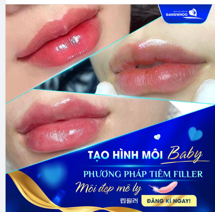 TẠO HÌNH MÔI BABY - PHƯƠNG PHÁP TIÊM FILLER MÔI ĐẸP MÊ LY