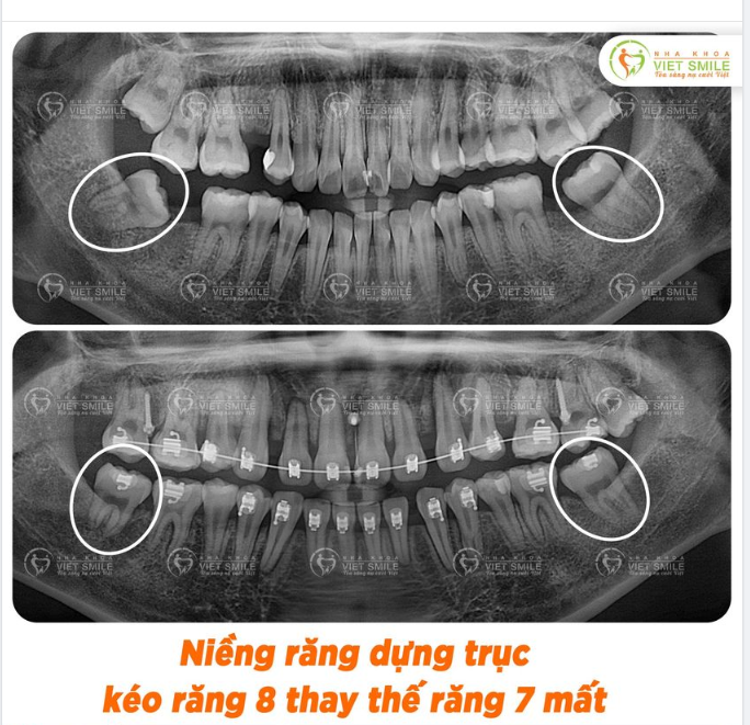 NIỀNG RĂNG DỰNG TRỰC KÉO RĂNG 8 MỌC LỆCH THAY THẾ RĂNG 7 MẤT