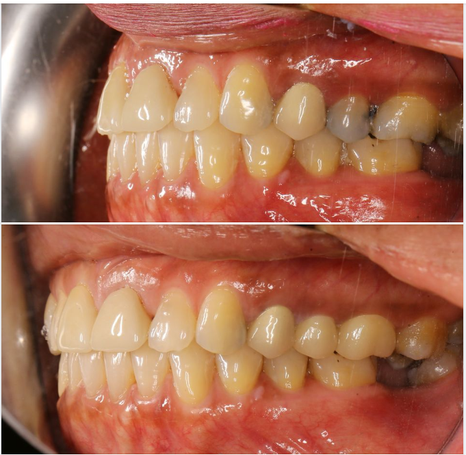 Một trường hợp làm phục hình răng sứ của bác sĩ Vũ, chi nhánh Sala, quận 2!