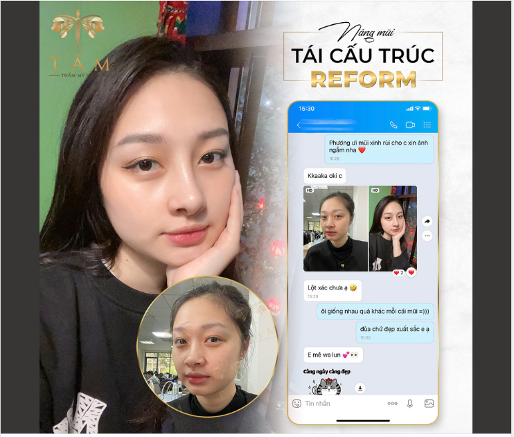 Lột xác thành Hotgirl với chiếc mũi 20 ngày tuổi