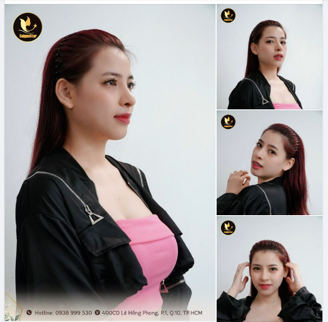 “Sau 15 ngày, em cảm thấy rất vui, nhiều khi soi gương mà em không nhận ra bản thân mình nữa. Cảm ơn Bác sĩ Hoạt và ekip Saigon Star” – Lê Như (Việt kiều Úc) chia sẻ.