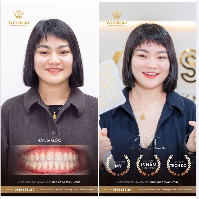 LÀM RĂNG SỨ GIỮ TRỌN NÉT CÁ TÍNH RIÊNG