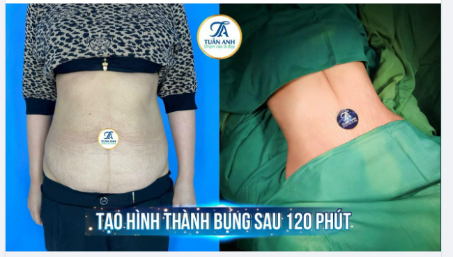 Thay đổi vòng 2 xuất sắc chỉ với 120p bằng phương pháp Hút mỡ, Tạo hình thành bụng