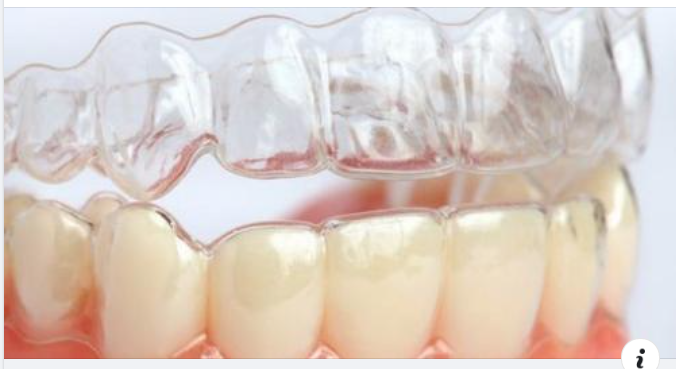 Giải pháp điều trị nghiến răng hiệu quả