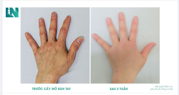 45 PHÚT CẤY MỠ TRẺ HOÁ: ĐÔI TAY MỊN MÀNG, TAY ĐẸP EM SANG!