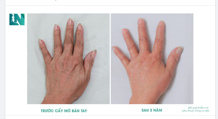 SỬ DỤNG MỠ TỰ THÂN LÀM ĐẸP CÓ ĐƯỢC LÂU DÀI?
