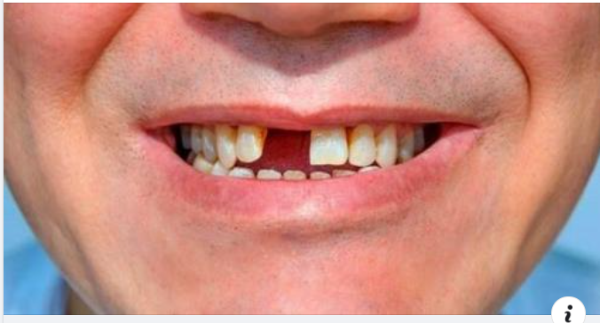 Không trồng răng giả sau khi nhổ răng có sao không?