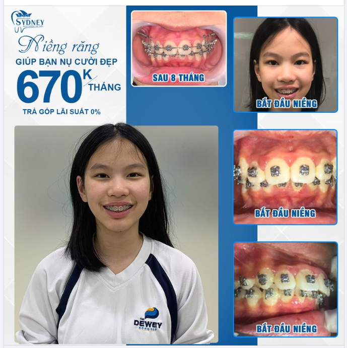 Tại sao cần niềng răng?