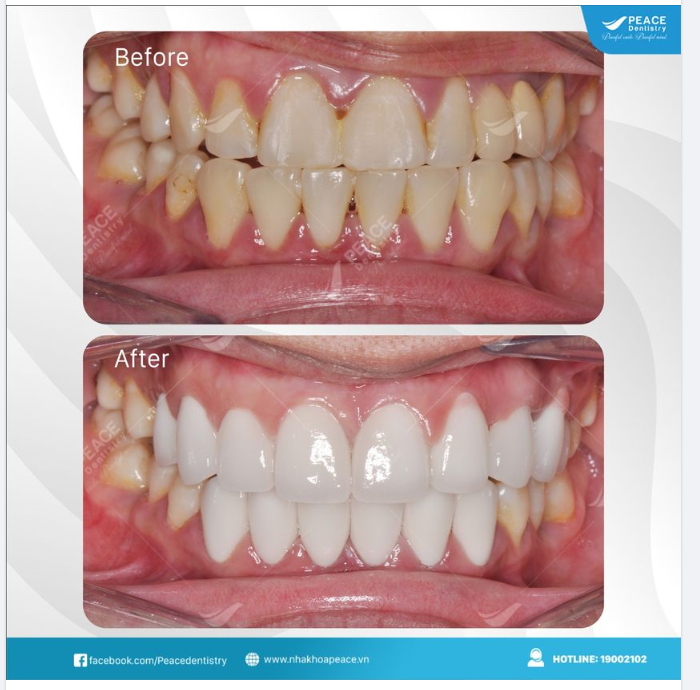 THẨM MỸ RĂNG SỨ (Zirconia DDBio - Dental Direkt)
