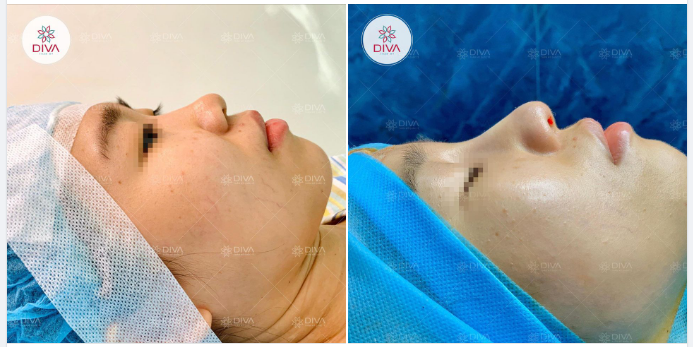 NÂNG MŨI TINY POINT - DÁNG MŨI CAO TỰ NHIÊN, CÂN ĐỐI