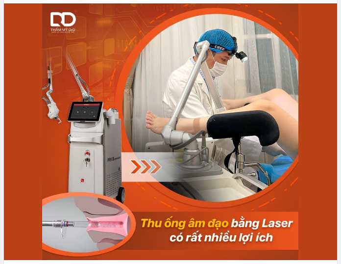 THU ỐNG ÂM ĐẠO BẰNG LASER CÓ RẤT NHIỀU LỢI ÍCH