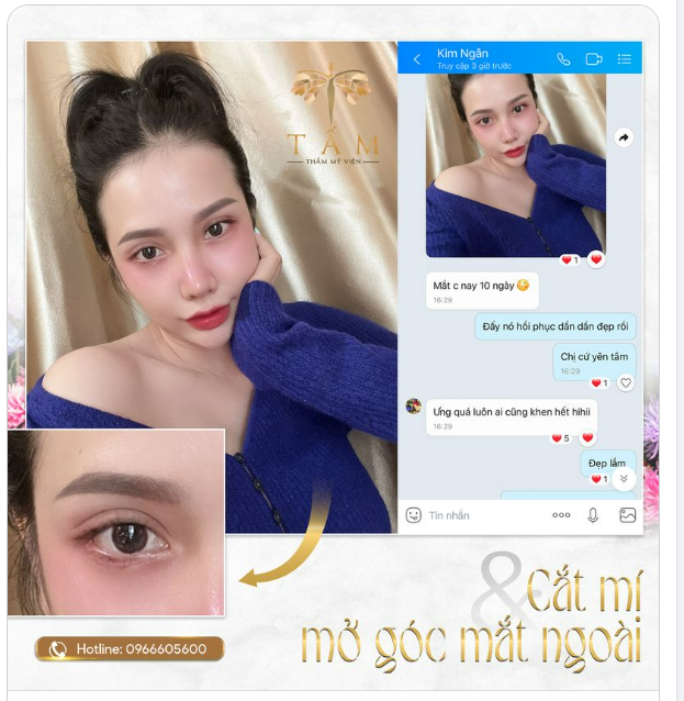 Đôi mắt 10 ngày tuổi combo Cắt mí  Mở góc mắt của Tấm