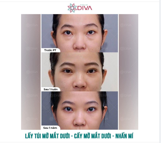 NHẤN MÍ - LẤY TÚI MỠ MẮT - CẤY MỠ MÍ MẮT SAU 1 NĂM SẼ NHƯ THẾ NÀO?