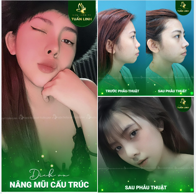 Nâng mũi cấu trúc - Sở hữu ngay dáng mũi chuẩn tỉ lệ vàng với khuôn mặt - Đẹp mọi góc nhìn