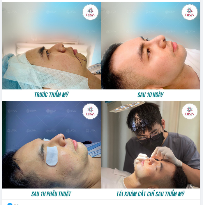 KẾT QUẢ THẨM MỸ SAU 10 NGÀY CẮT CÁNH MŨI, NÂNG MŨI TÁI CẤU TRÚC GHÉP SỤN TỰ THÂN