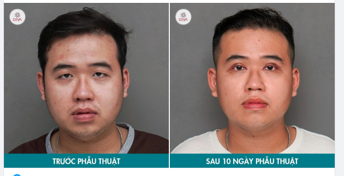 MẮT MỘT MÍ, YẾU CƠ NÂNG MI - PHƯƠNG PHÁP NÀO CẢI THIỆN?