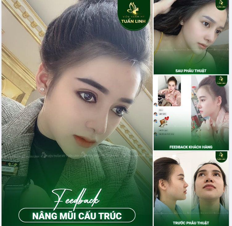 Feeback nâng mũi tại Tuấn Linh!!