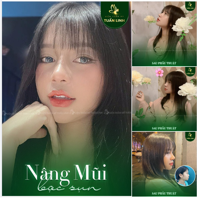 Nâng mũi bọc sụn - Khắc phục hoàn toàn tình trạng sống mũi thấp tẹt bẩm sinh.