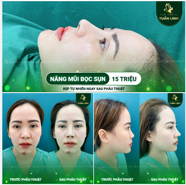 MŨI THẤP TẸT CHỈ CÒN LÀ QUÁ KHỨ!!