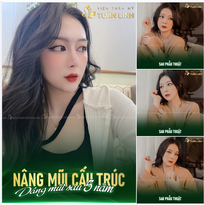 Feedback khách hàng. Dáng mũi cao xinh sau 5 năm nâng mũi cấu trúc