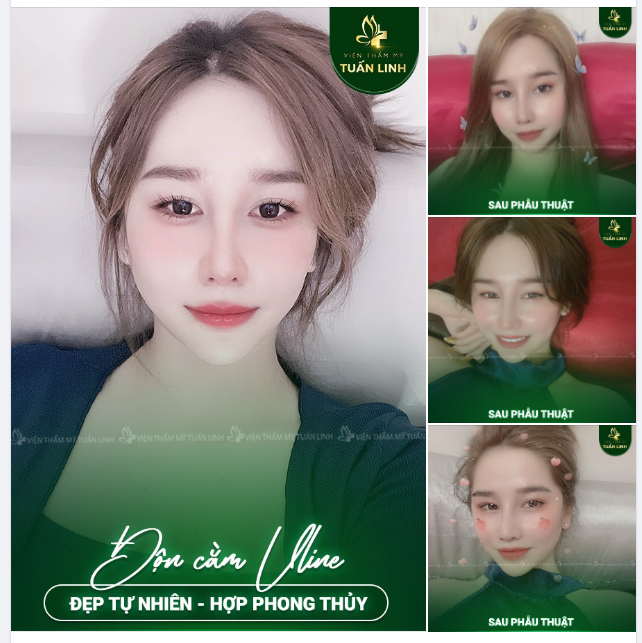 Cái giá phải trả cho chiếc cằm Vline xinh đẹp này - Chỉ từ 15TR - Sở hữu ngay chiếc cằm thon gọn, đẹp thanh tú.