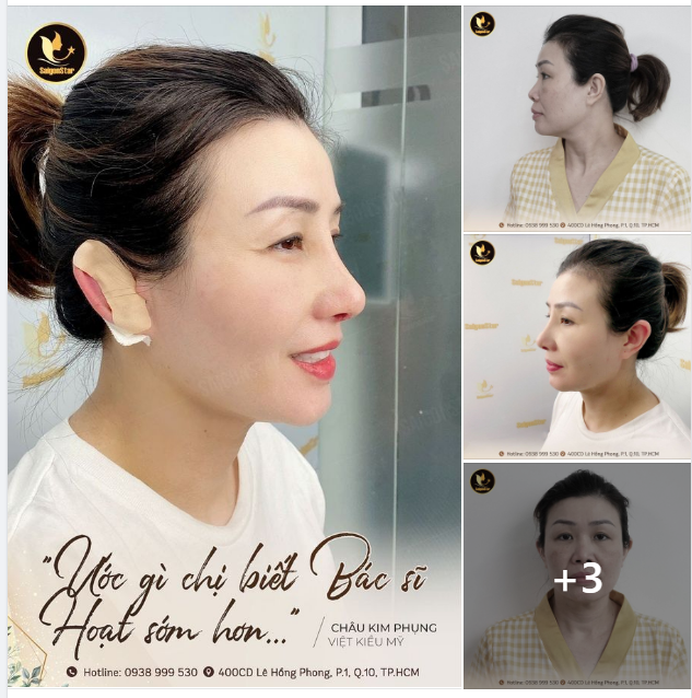 10 ngày sau nâng mũi, chị Kim Phụng cực kỳ hài lòng với kết quả.