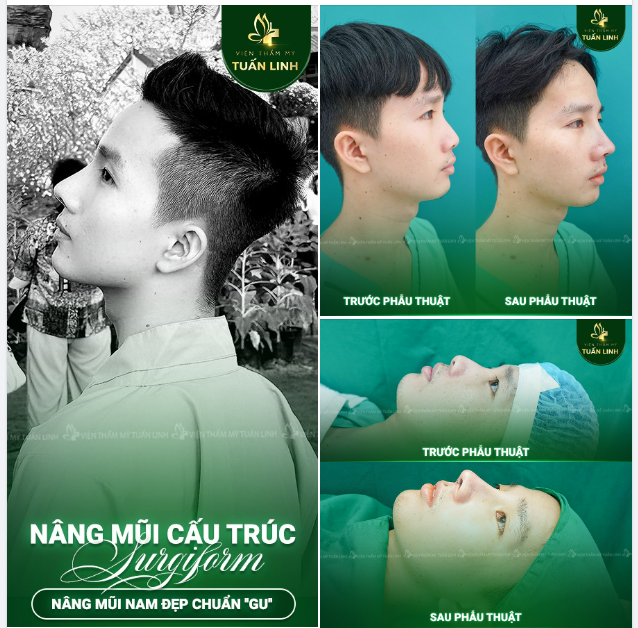 NÂNG MŨI NAM - ĐẸP CHUẨN ''GU''!!