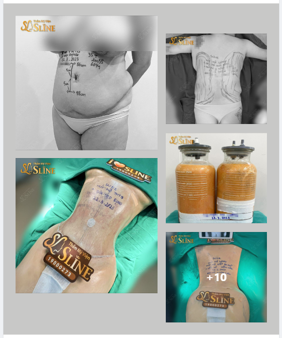 “TAN BIẾN” HƠN 4 LÍT MỠ THỪA ❝GIẢI PHÓNG❞ BODY