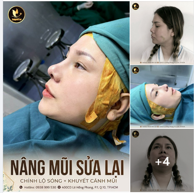NÂNG MŨI SỬA LẠI CHỈNH LỘ SÓNG VÀ KHUYẾT CÁNH MŨI