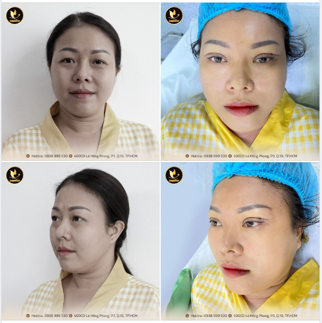 CẬN CẢNH KẾT QUẢ MÍ SAU 30P